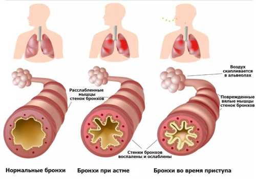 Что такое астма