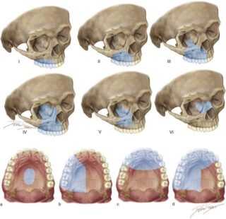 Виды дефектов челюстей: классификация аномалий и их определение, причины деформаций
