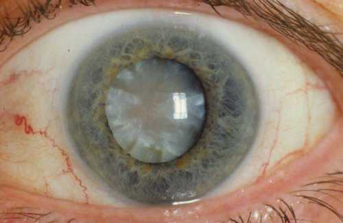 Восстановление организма после удаления катаракты